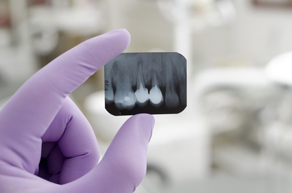 Implanty zębów - zdjęcie RTG