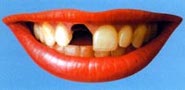 Implanty zębów - wygląd dziąsła