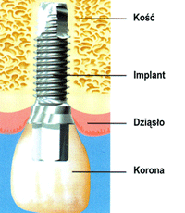 Implant osadzony