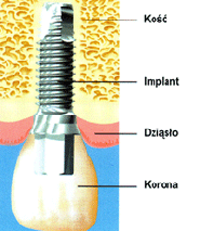 Implant został chirurgicznie wprowadzony na miejsce po usuniętym zębie. Nowa korona zostanie później osadzona na implancie.