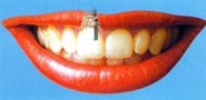 Ceramic crown on the implant