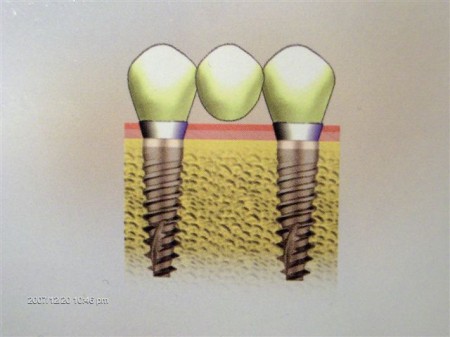 Implanty dwufazowe - schemat trzeci