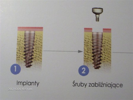 Implanty dwufazowe - schemat pierwszy