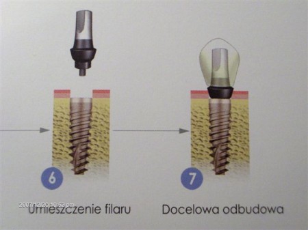 Implanty dwufazowe - schemat drugi