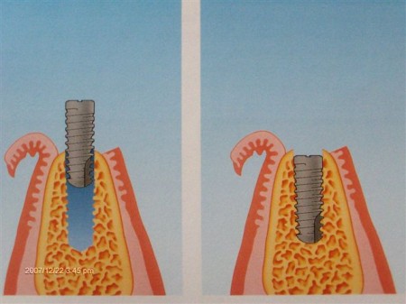 Wkręcanie implantu w kość - schemat drugi