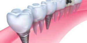 Implanty dentystyczne