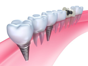 Implanty dentystyczne