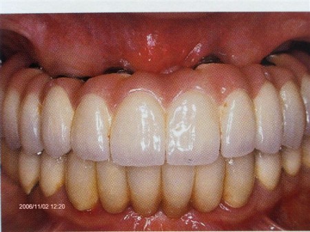 Implantacja - most porcelanowy - efekt końcowy