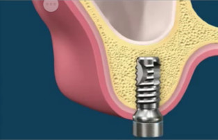 Podniesienie dna zatoki - wprowadzony implant w kość pod dnem zatoki