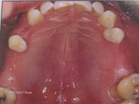 Implantacja - punkt zębowy
