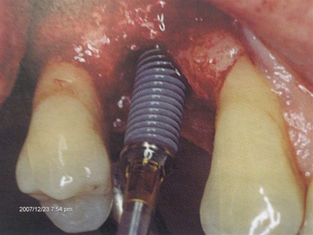 Wszczepienie implantu