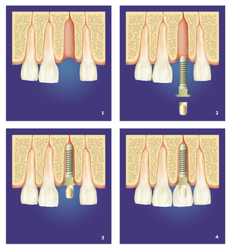 Schemat zabiegu wszczepiania implantu zęba
