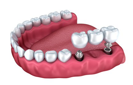 Szczęka z implantami zębów