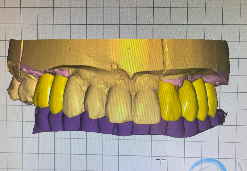 Wizualizacja uzupełnienia protetycznego w oprogramowaniu CAD.