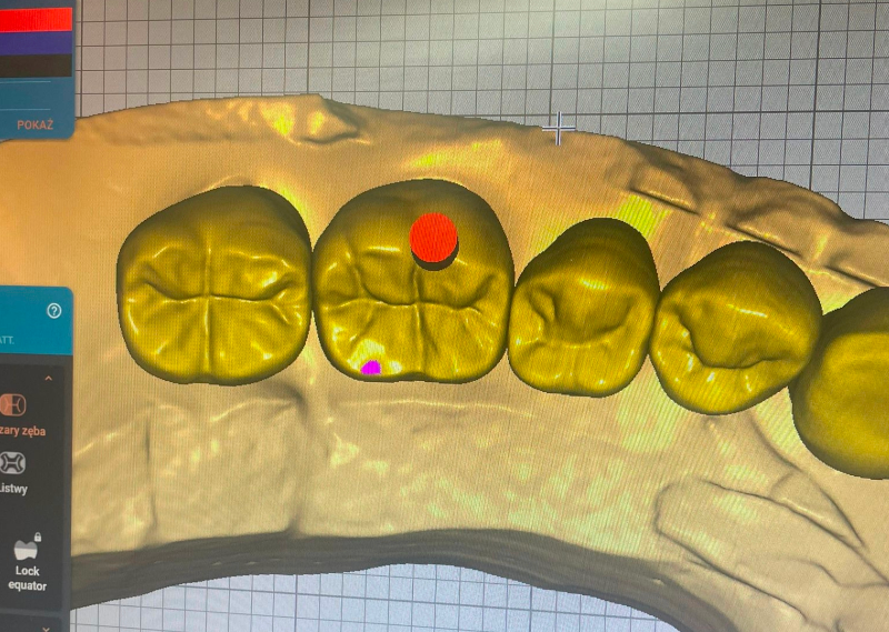 Oprogramowanie CAD w stomatologii tworzy wizualizację uzupełnień protetycznych.