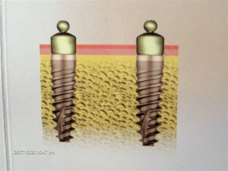 Zatrzaski na implantach dwufazowych